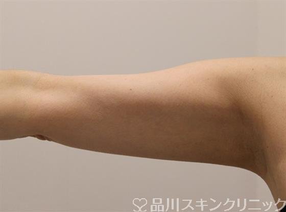 症例NO.46986のAFTER写真