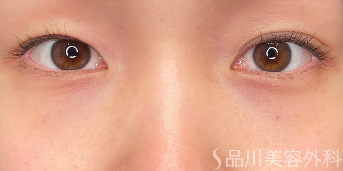症例NO.65558のAFTER写真