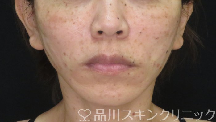 症例NO.72148のAFTER写真