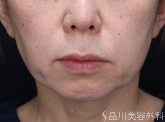 症例NO.73098のBEFORE写真