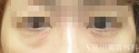 症例NO.75244のBEFORE写真
