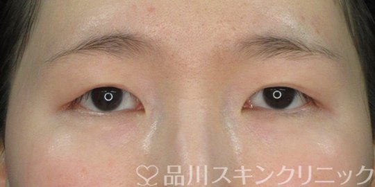 症例NO.73227のAFTER写真