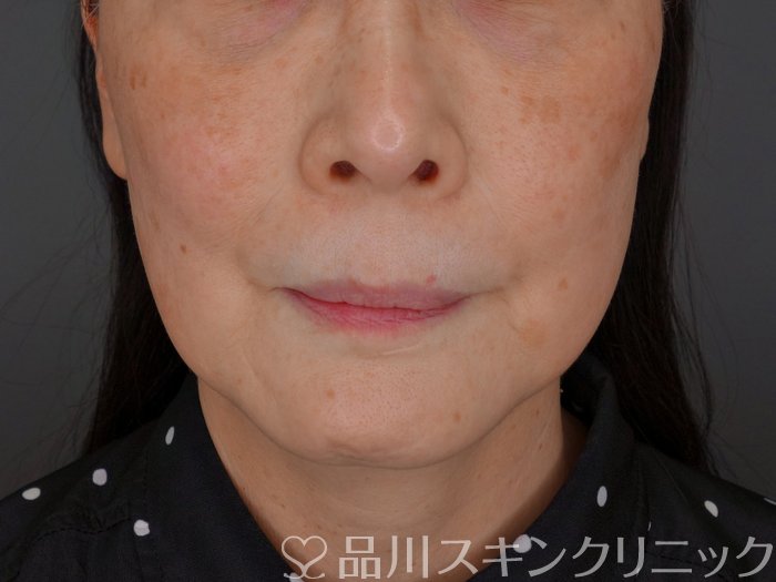 症例NO.73049のBEFORE写真
