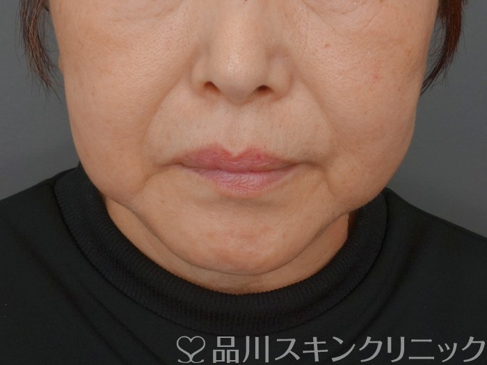 症例NO.72035のBEFORE写真