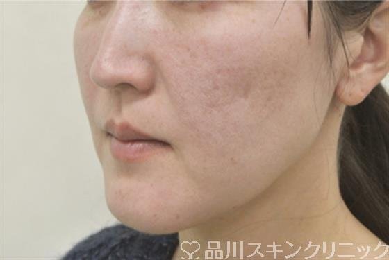 症例NO.31244のBEFORE写真