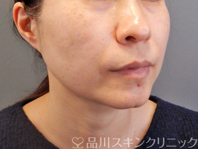 症例NO.67597のAFTER写真