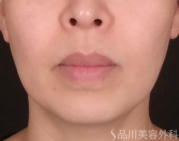 症例NO.69794のBEFORE写真