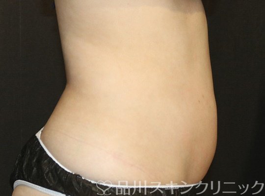 症例NO.72075のBEFORE写真