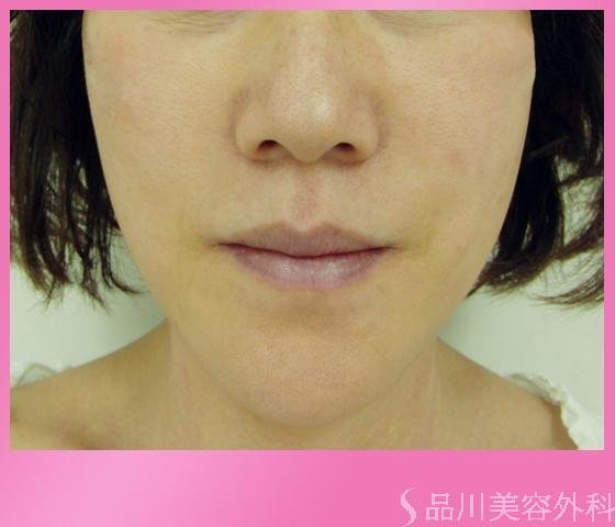 症例NO.1173のAFTER写真