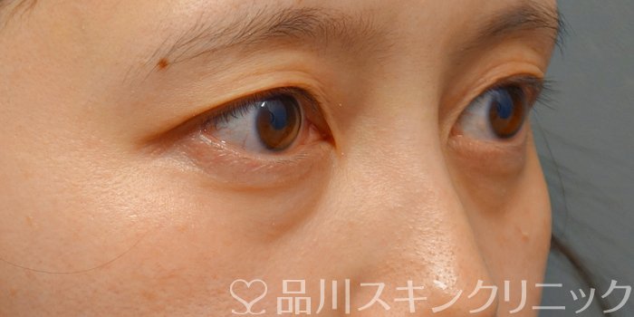 症例NO.73069のBEFORE写真