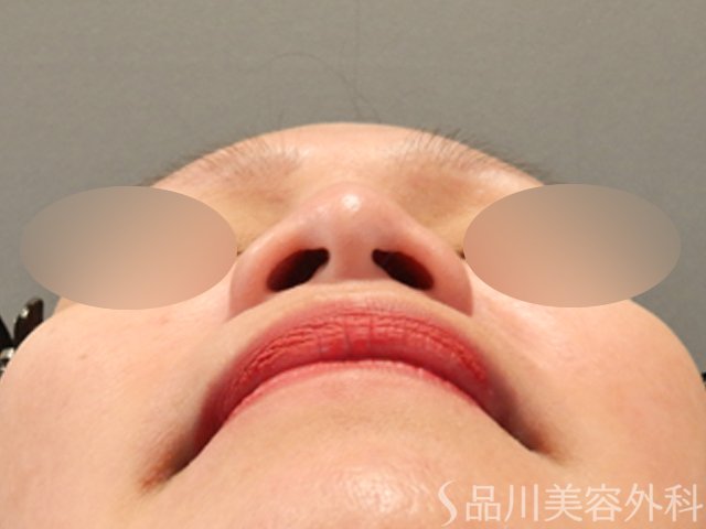 症例NO.71796のBEFORE写真