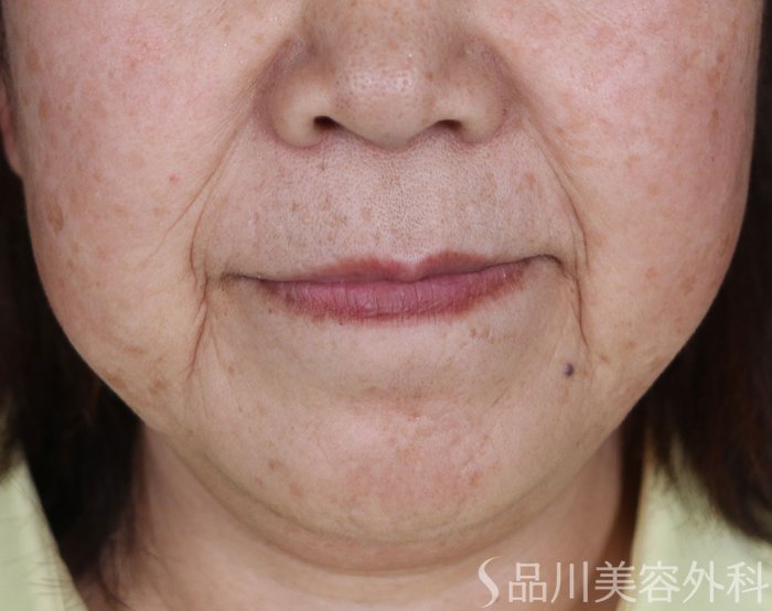 症例NO.74059のBEFORE写真