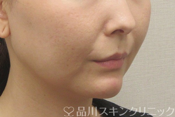 症例NO.72405のAFTER写真