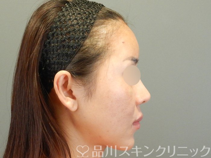 症例NO.65033のAFTER写真