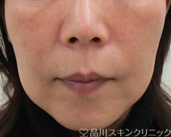 症例NO.41814のBEFORE写真