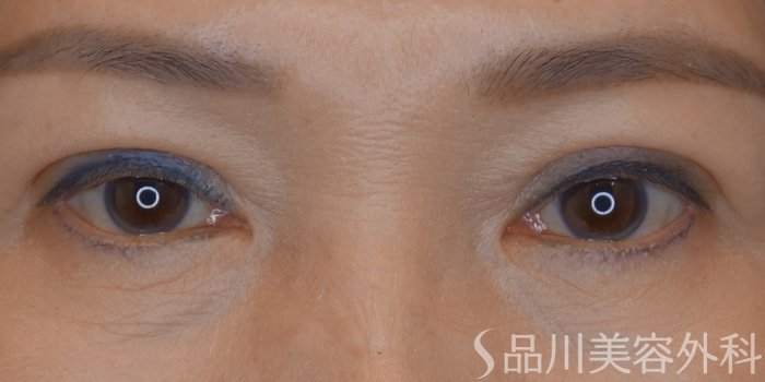 症例NO.68309のAFTER写真
