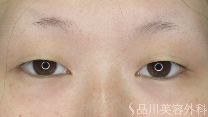 症例NO.65245のBEFORE写真