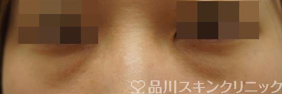 症例NO.35428のBEFORE写真