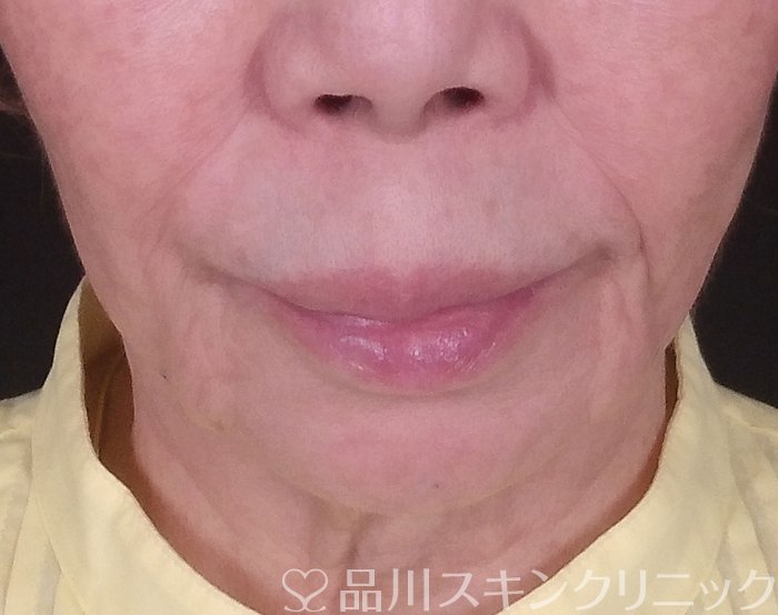症例NO.69902のBEFORE写真