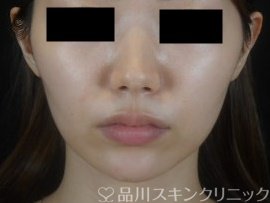 症例NO.74305のAFTER写真