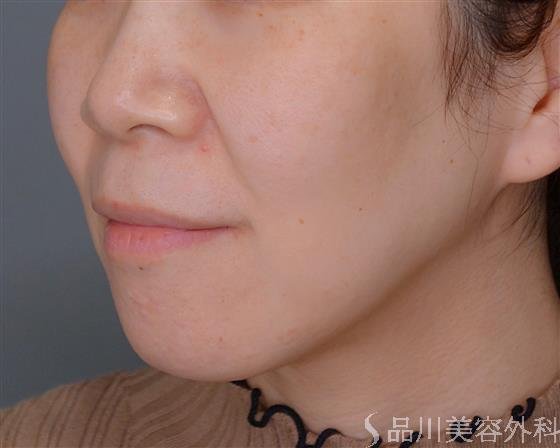 症例NO.53310のBEFORE写真