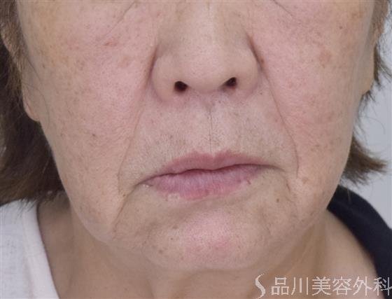 症例NO.49567のBEFORE写真