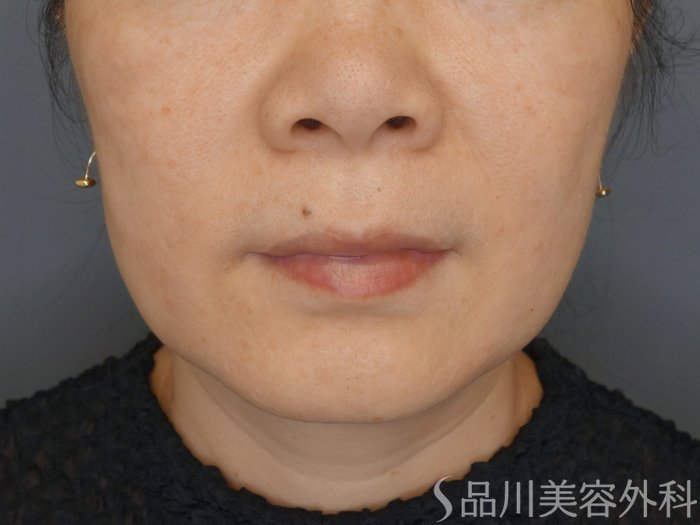 症例NO.71873のBEFORE写真