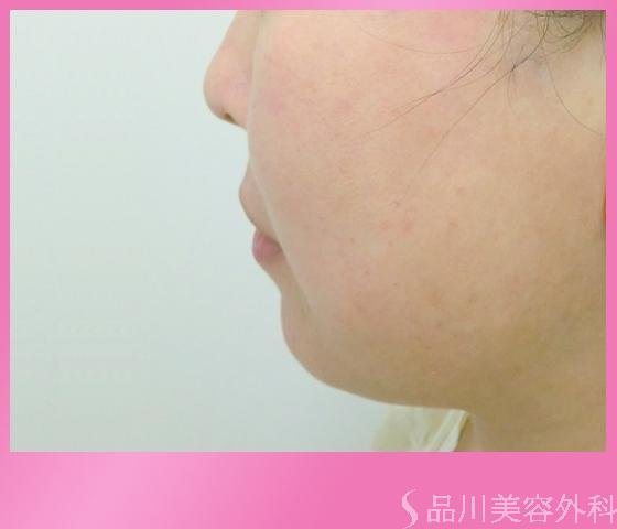 症例NO.1496のAFTER写真