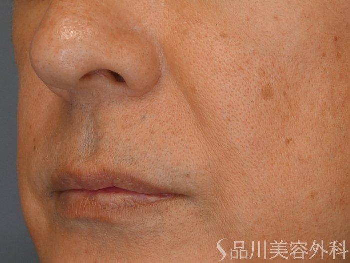 症例NO.67833のBEFORE写真