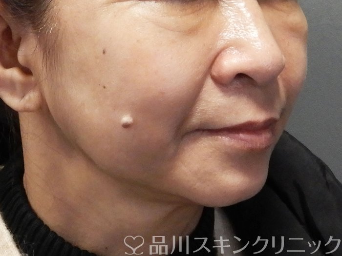 症例NO.72395のAFTER写真