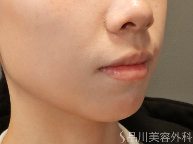 症例NO.72718のBEFORE写真