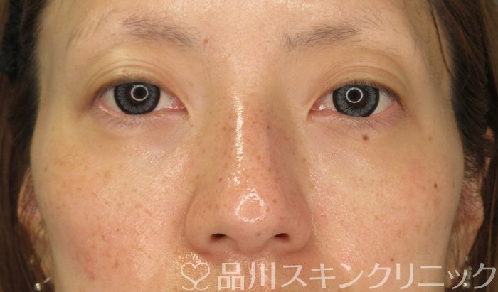 症例NO.73870のAFTER写真