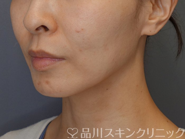 症例NO.71717のBEFORE写真