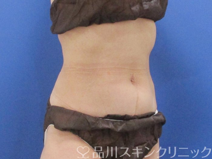 症例NO.69803のAFTER写真