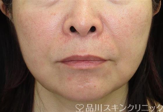 症例NO.58745のAFTER写真