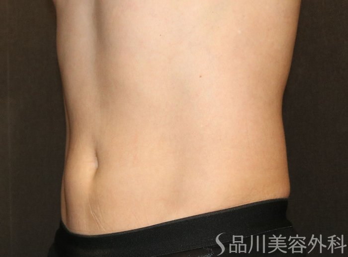 症例NO.73683のAFTER写真