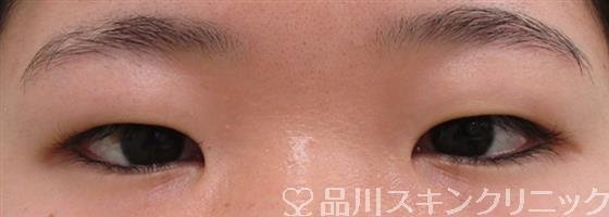 症例NO.41630のBEFORE写真
