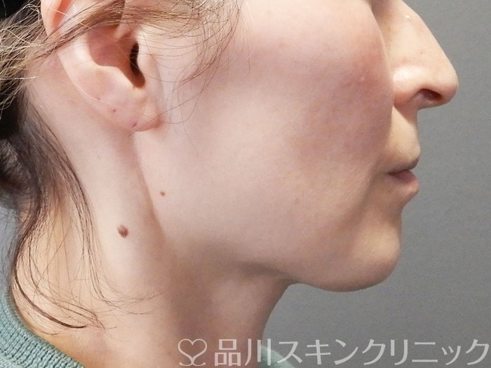 症例NO.72979のBEFORE写真