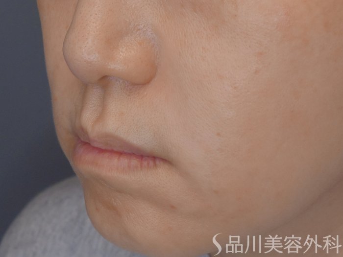 症例NO.72391のAFTER写真