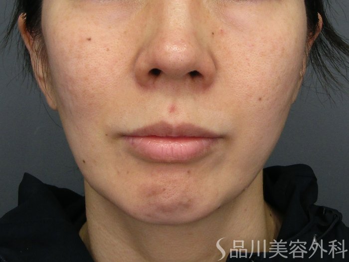 症例NO.75010のBEFORE写真