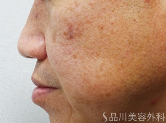 症例NO.70889のBEFORE写真
