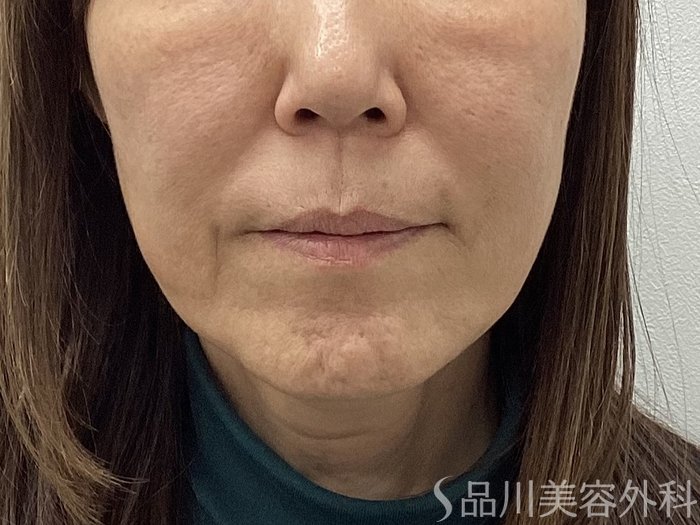 症例NO.69548のBEFORE写真