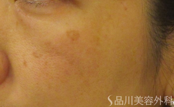 症例NO.65272のBEFORE写真