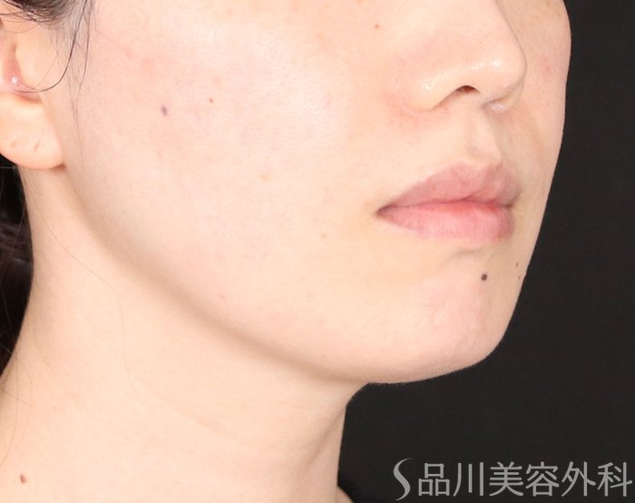 症例NO.73979のBEFORE写真