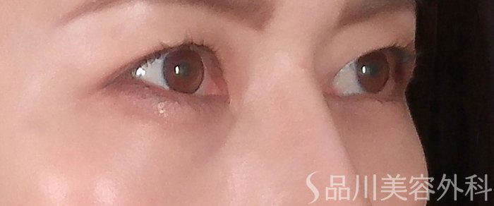 症例NO.70613のAFTER写真