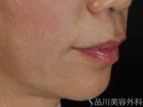 症例NO.72524のAFTER写真