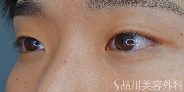症例NO.70414のBEFORE写真