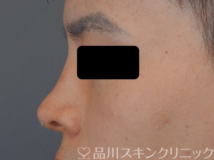 症例NO.74675のAFTER写真