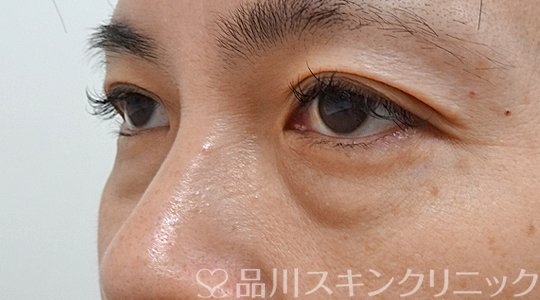 症例NO.63393のBEFORE写真