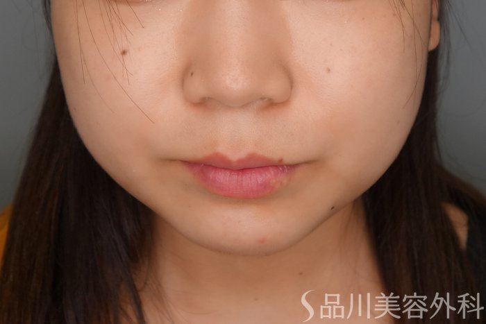 症例NO.70066のAFTER写真